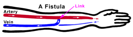 Formation of Fistula for Haemodialysis | Hull University Teaching ...