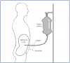 Insertion Of A Peritoneal Dialysis Catheter 