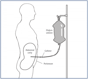 Insertion of a Peritoneal Dialysis Catheter | Hull University Teaching ...