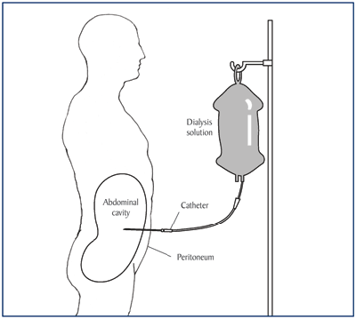 Diagram showing position of peritoneal dialysis catheter
