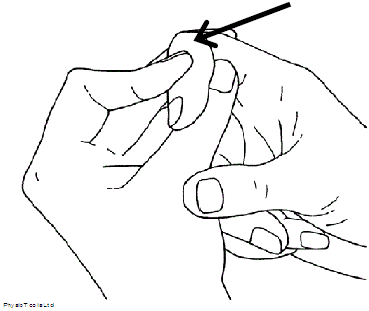 Mallet Finger – Symptoms and Management | HEY Hospitals NHS Trust