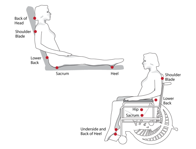 Preventing Pressure Ulcers - Working Together with Patients and Carers ...