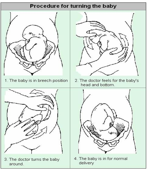 what are examples of breech presentation