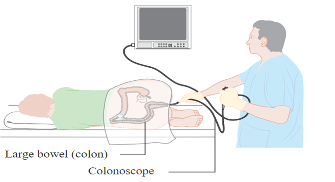 Image of the insertion of a colonoscope