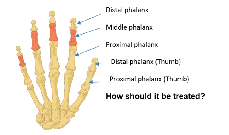 Hand Therapy Phalangeal Fractures Of The Fingers Or Thumb Hull 