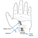 Carpal Tunnel Syndrome: Your Diagnosis and Treatment Options | Hull ...