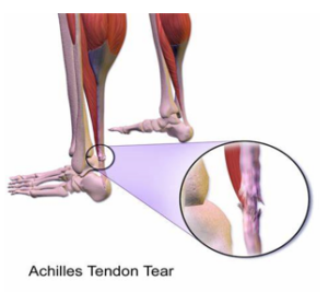 Image showing Achilles Tendon tear