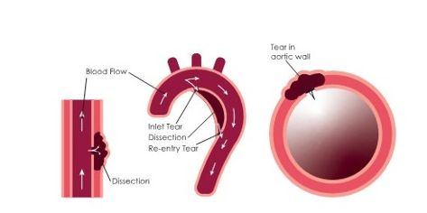 Diagrams showing aortic dissection - a tear in the aorta