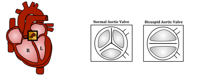 Diagram of Bicuspid Aortic Valve